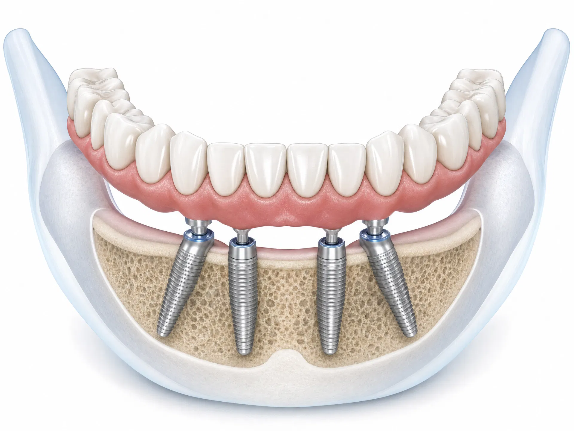 Full arch All-on-4 dental implant illustration