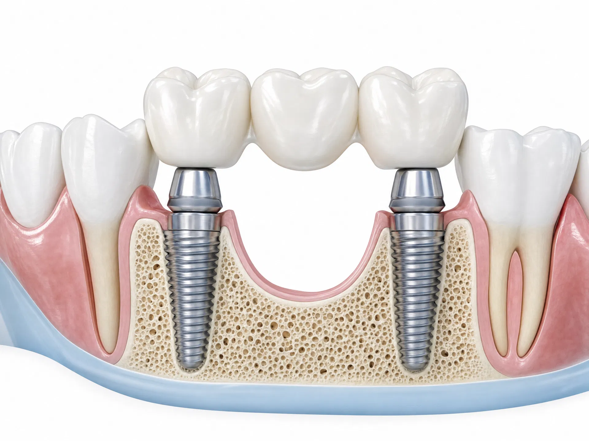 Dental implant bridge illustration