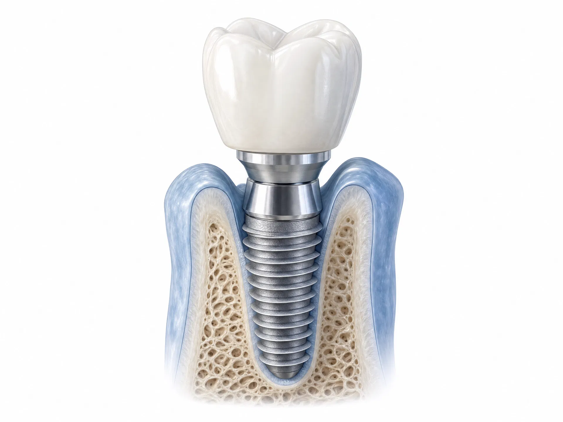Single dental implant illustration