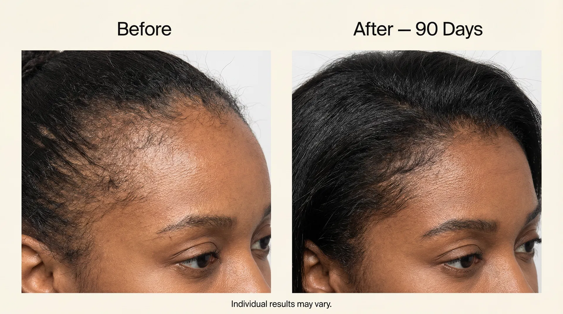 Before and after: Black woman's thinning edges restored to full, healthy hairline after 90 days with Trufollic