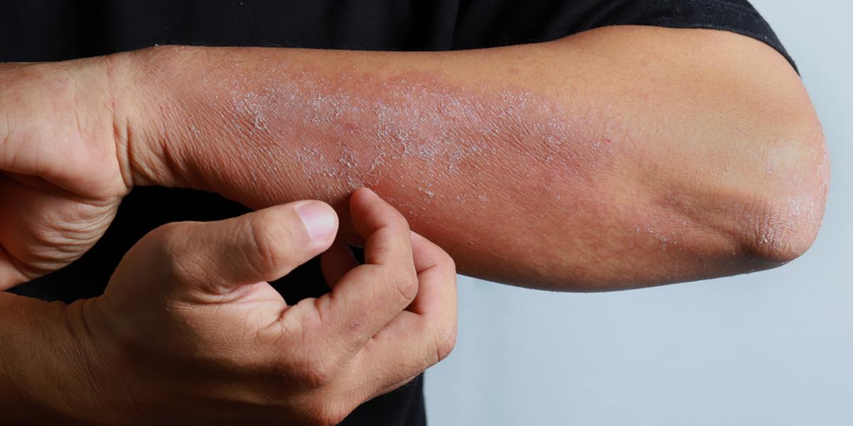 Dermatites