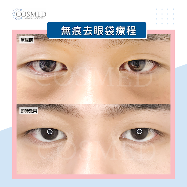 COSMED 映匯醫學集團(尖沙咀) - 醫學美容,微創去眼袋及吊線雙眼皮中心