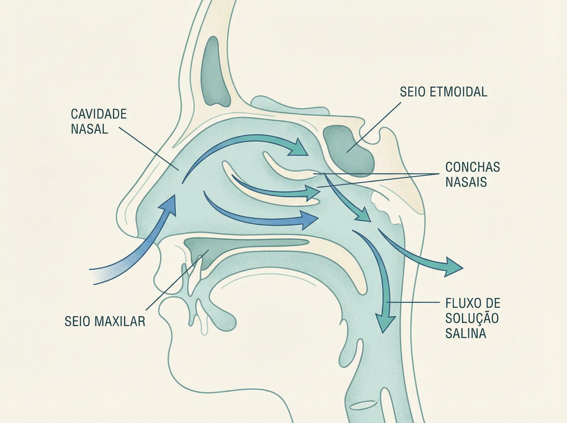 Ilustração da anatomia nasal mostrando o fluxo da solução salina durante a lavagem