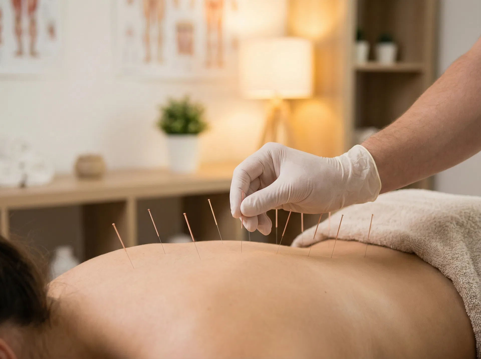 ฝังเข็ม