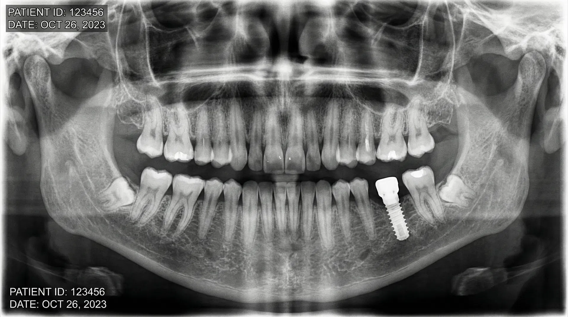 Why Some Dental Implants Fail