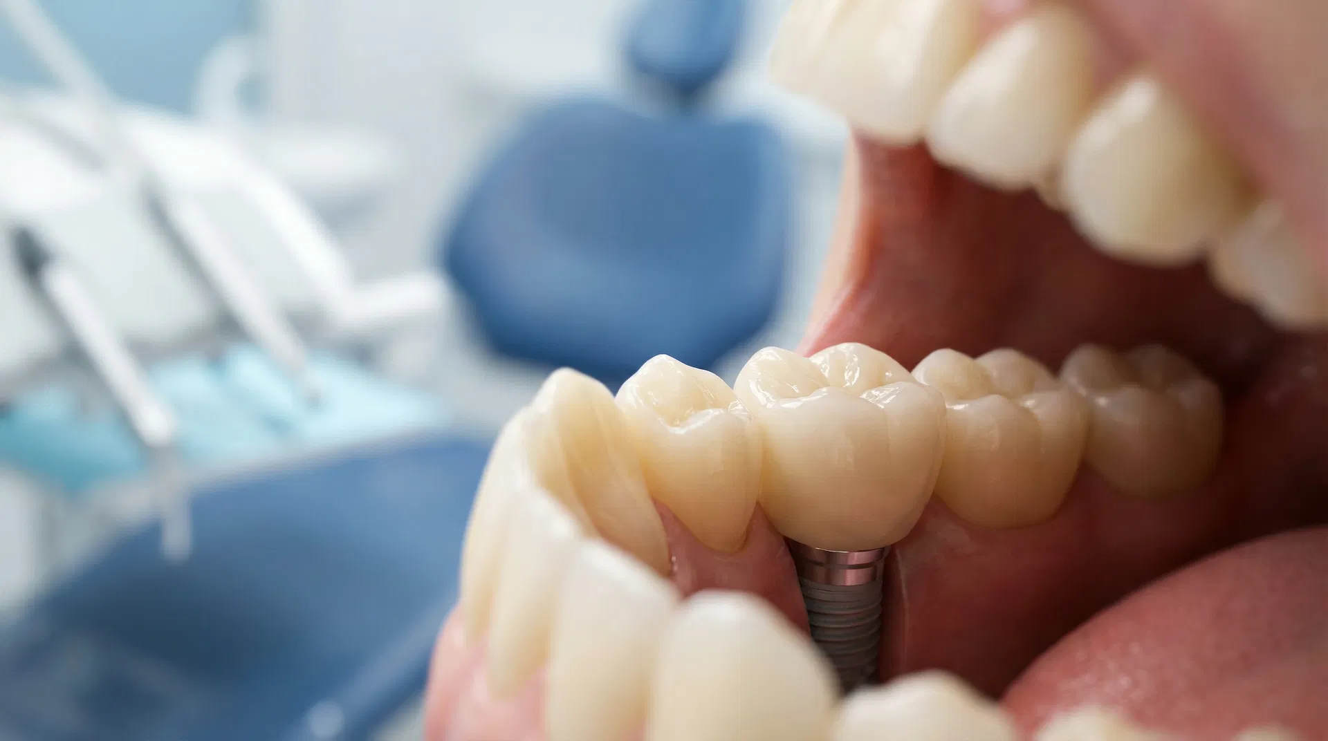 The Benefits of Zirconia Crowns: Why They're the Gold Standard in Modern Dentistry