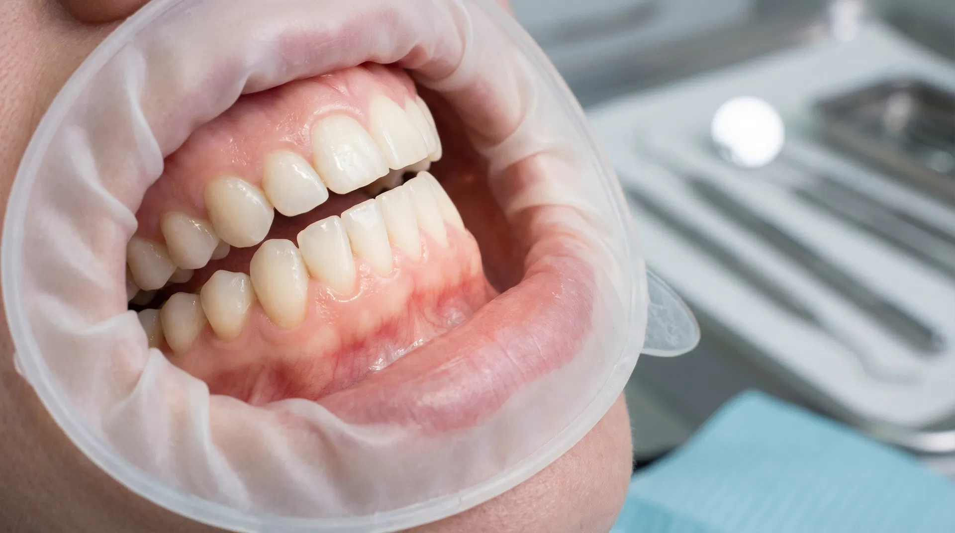 Gum Grafting treatment