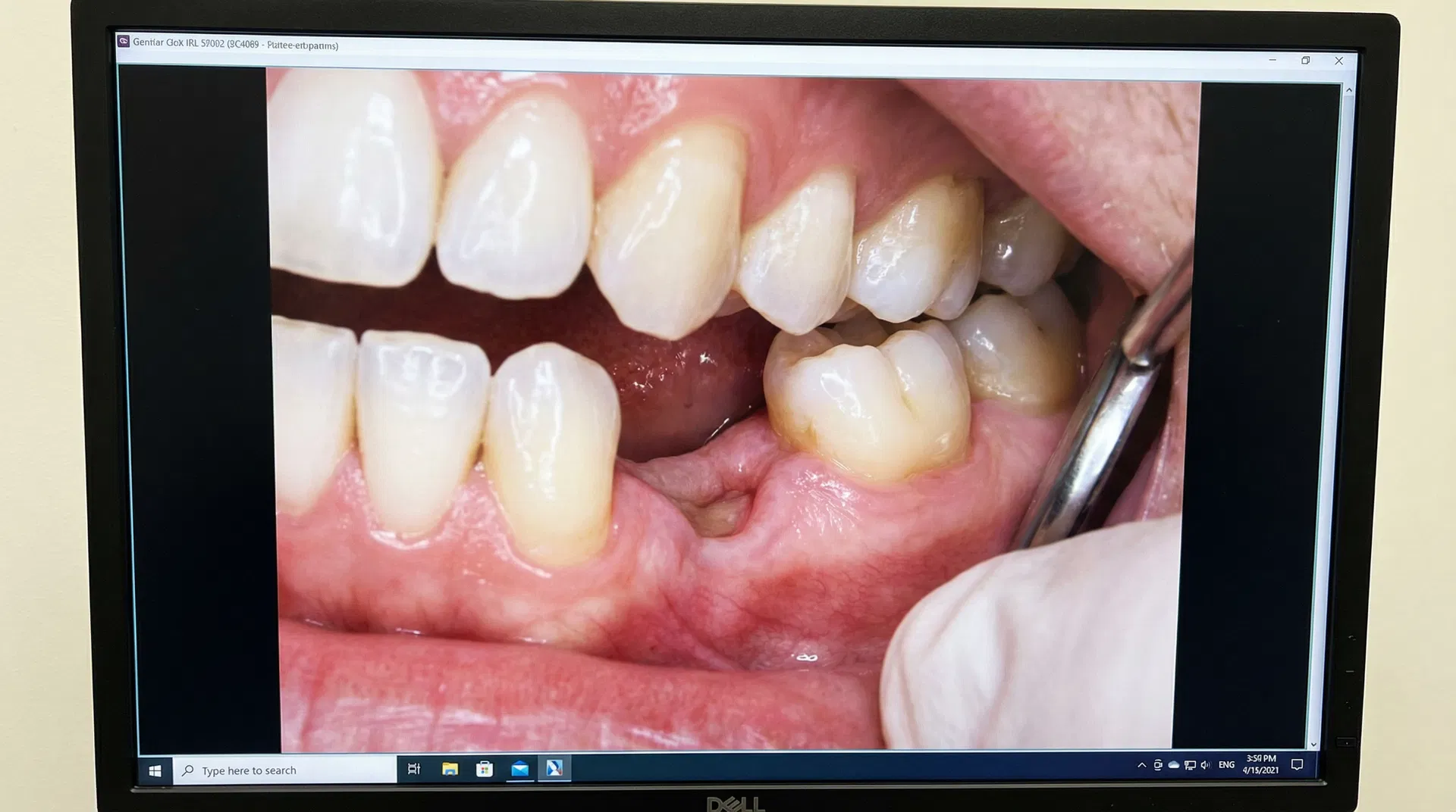 What Happens If You Don't Replace a Missing Tooth?