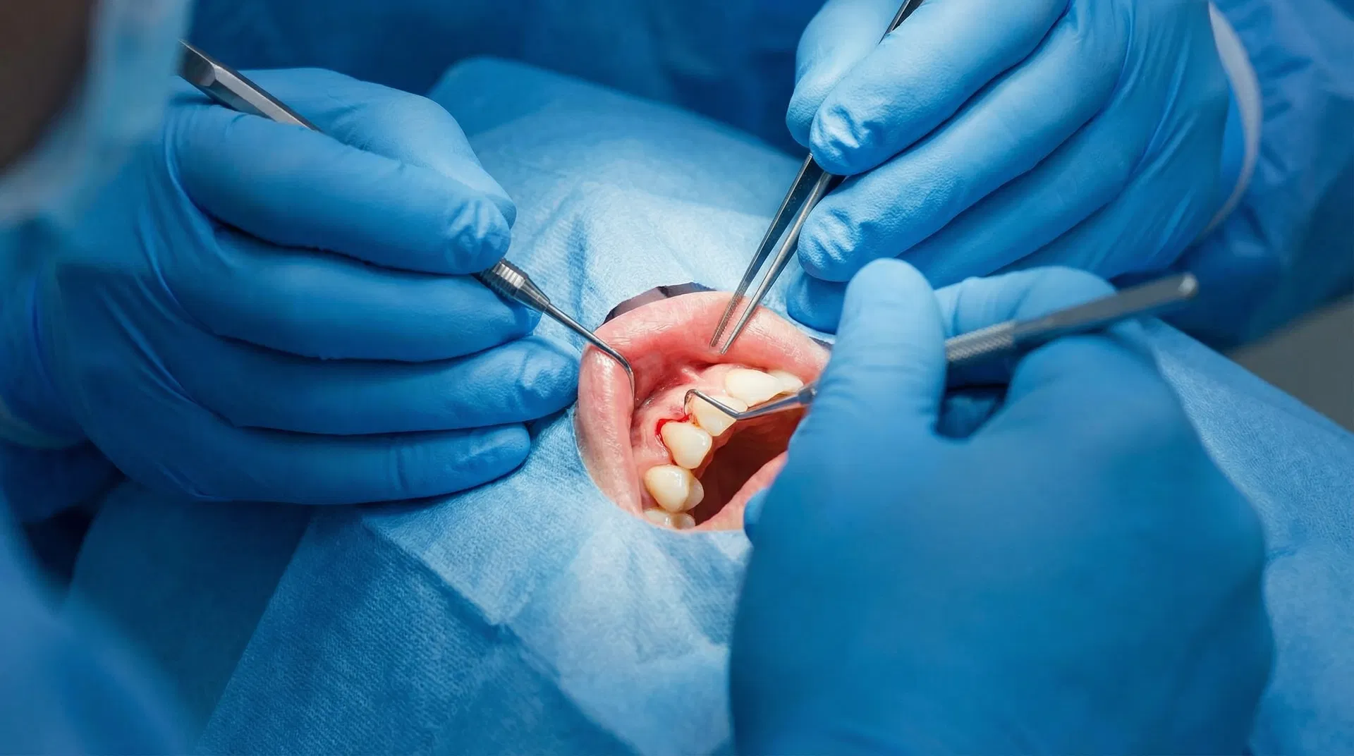 Open Flap Debridement treatment