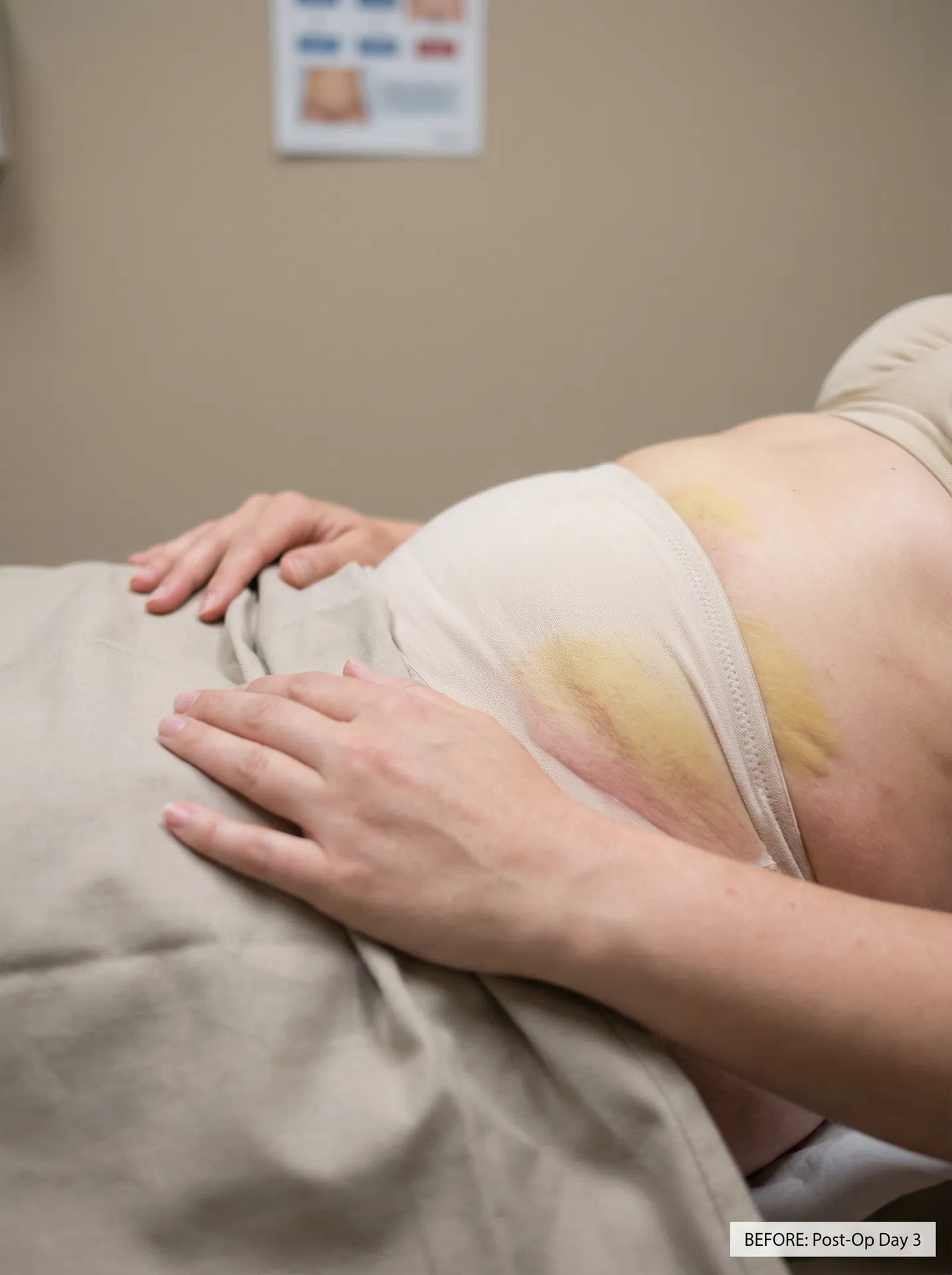 Antes — Pós-Operatório de Lipoaspiração