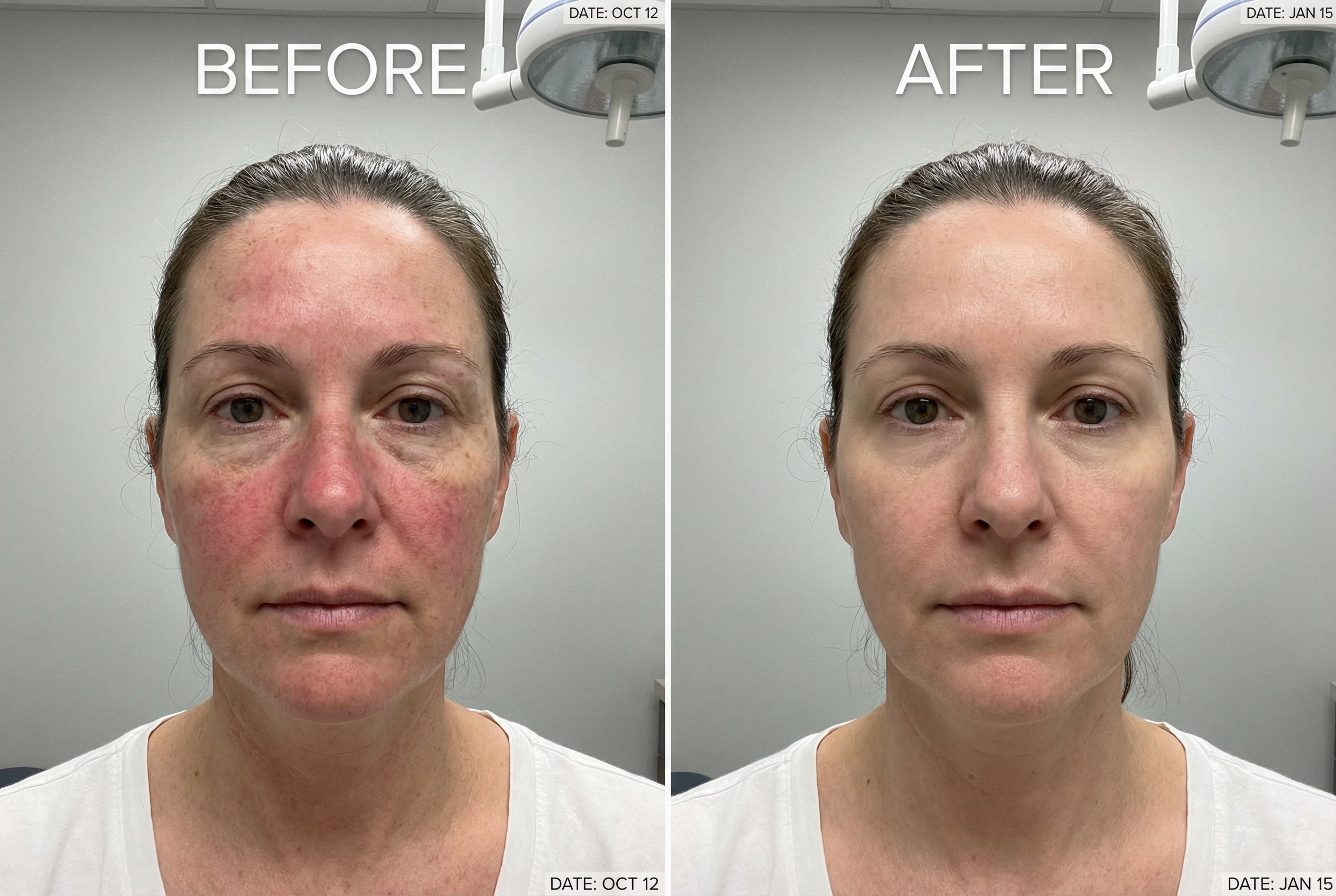 DPL NIR Photofacial before and after results