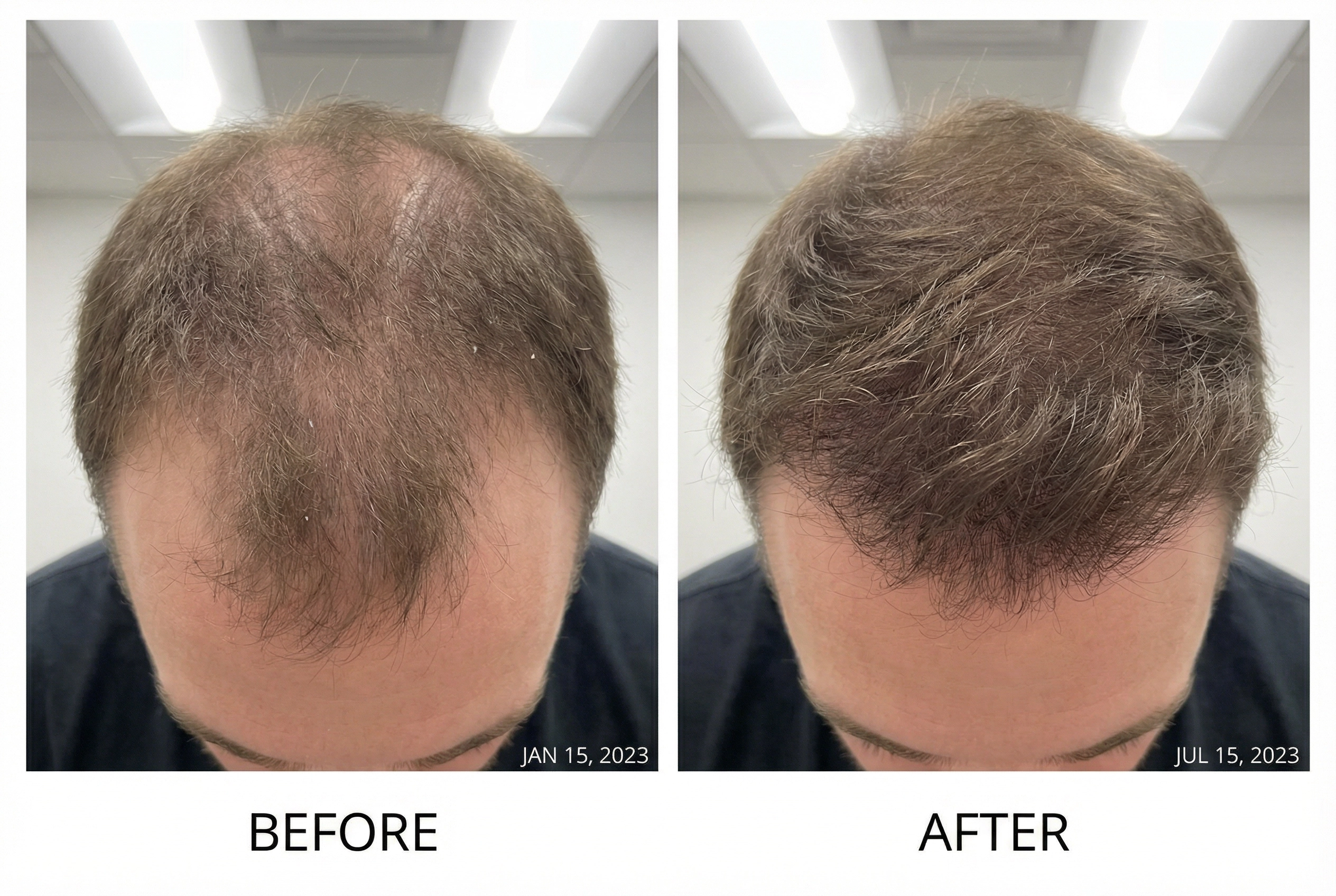 LLLT laser hair restoration before and after results