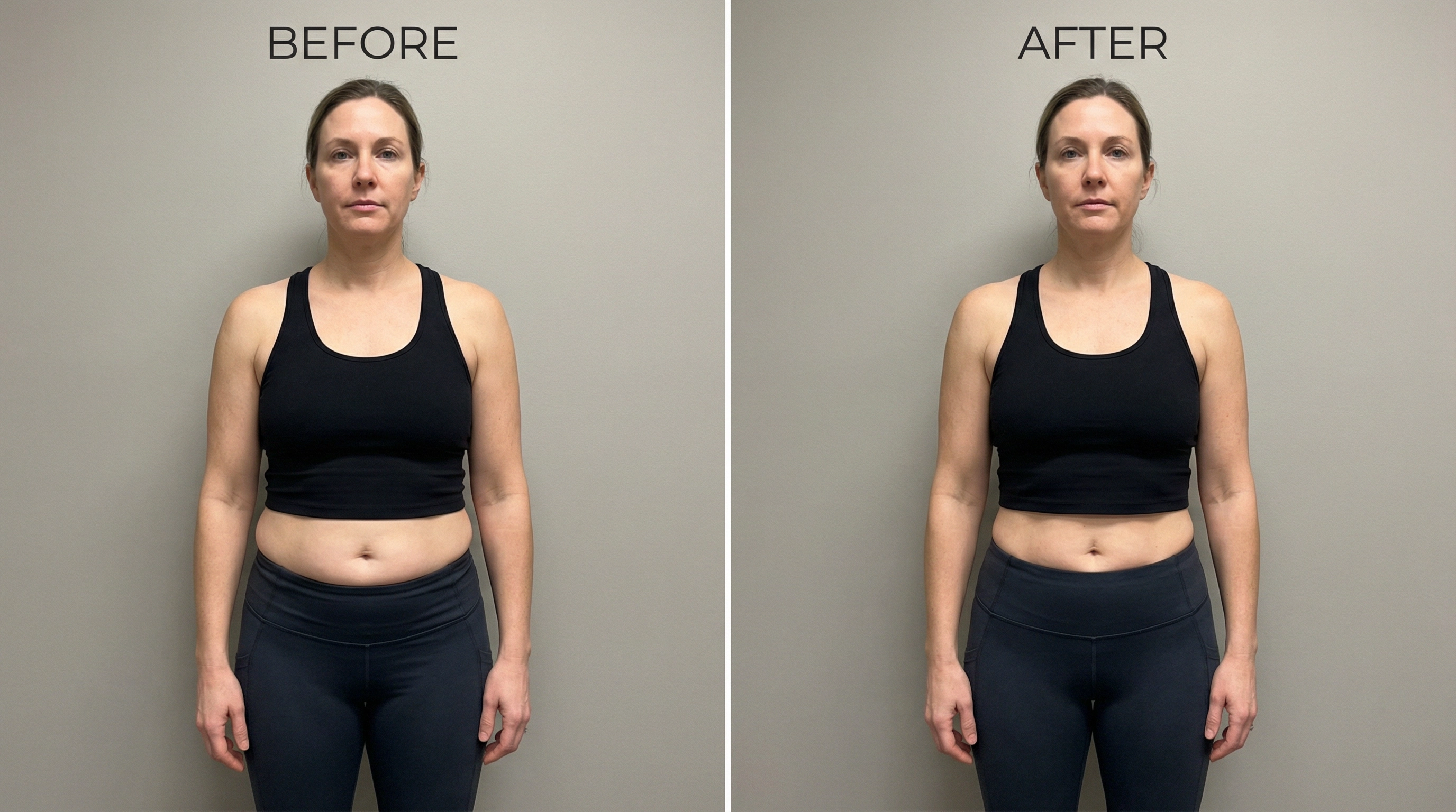 RenaSculpt HIFEM muscle toning before and after results