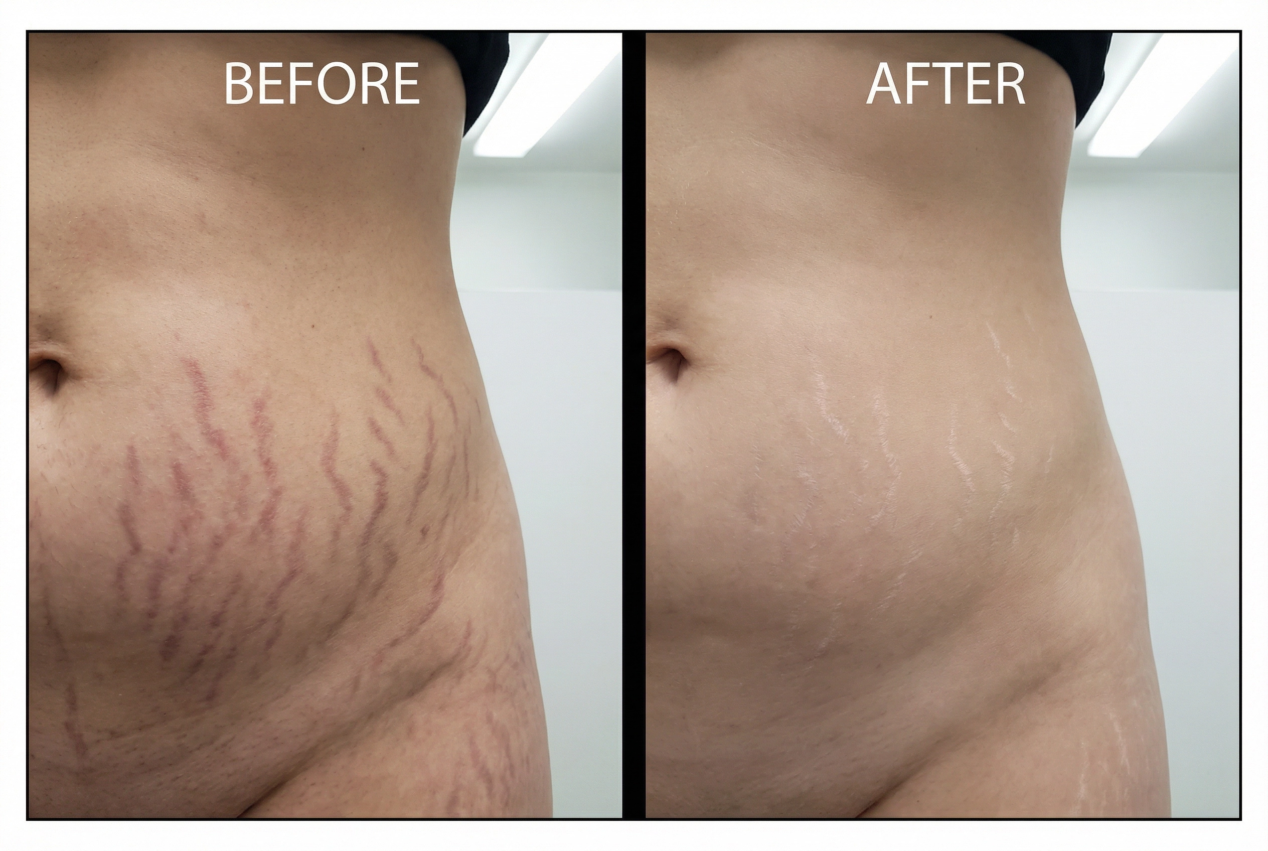 Stretch mark treatment before and after results