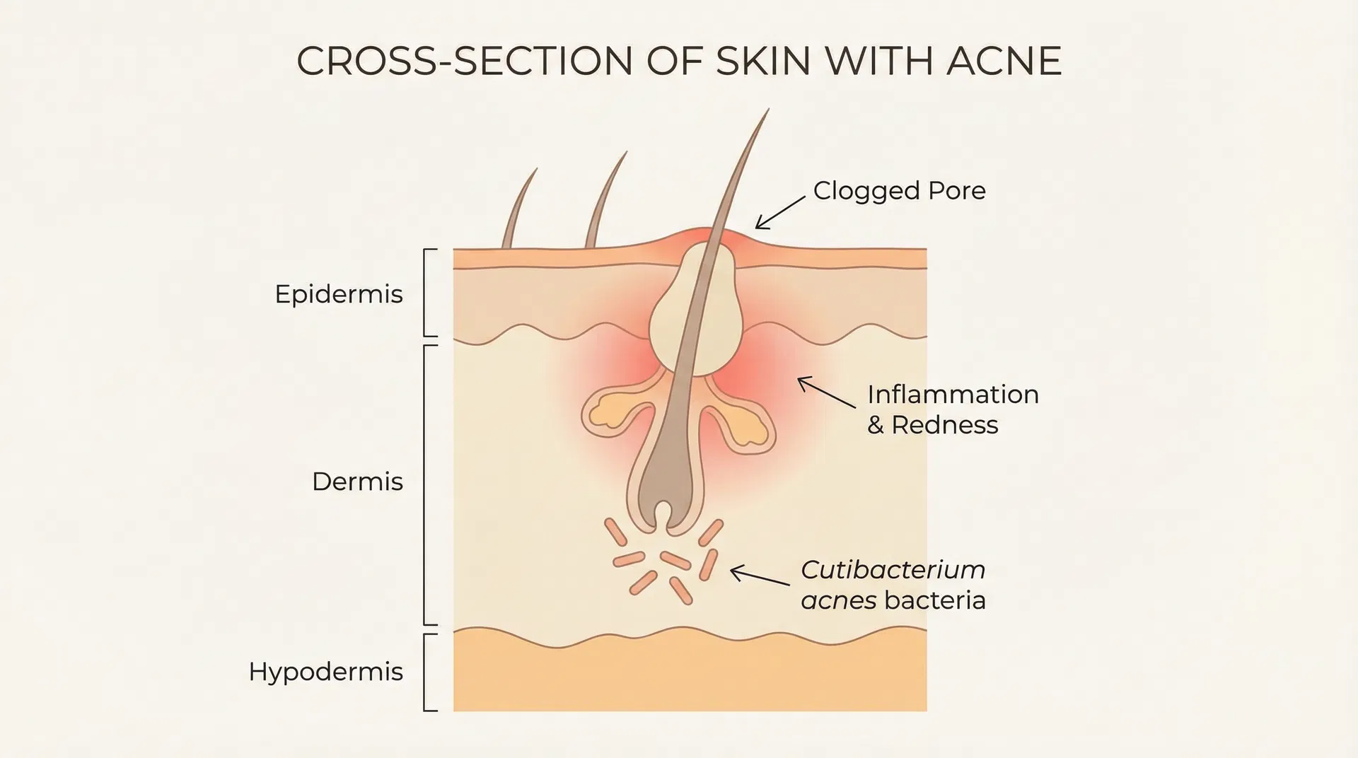 Scientific dermatology illustration showing cross-section of skin layers with clogged pores, bacteria, inflammation, and redness