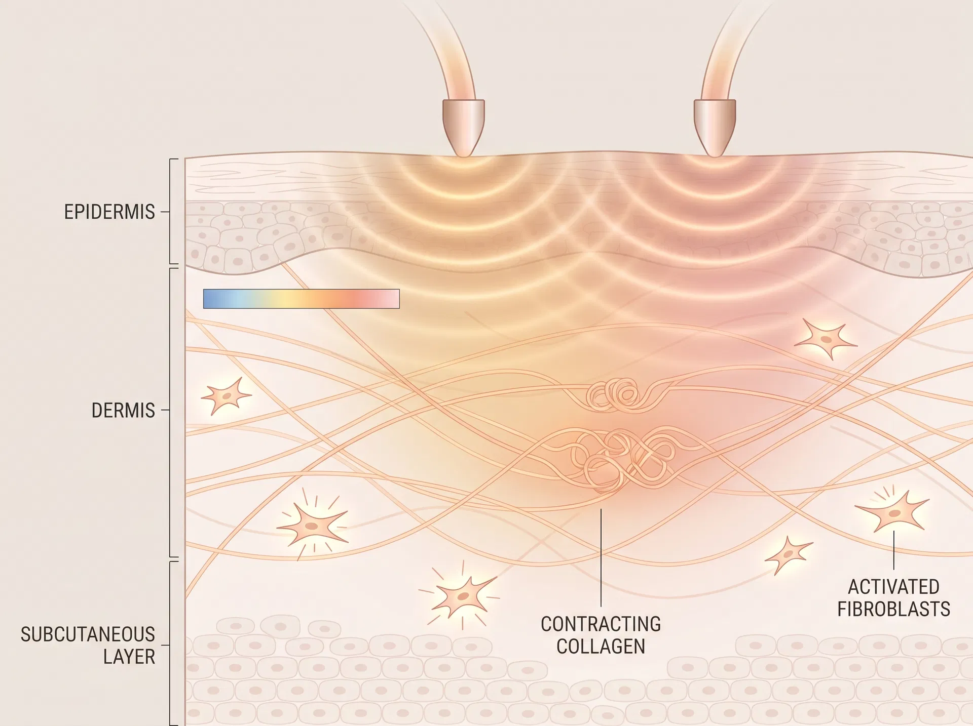 Radiofrequency diffuse energy field creating bulk dermal heating with collagen activation