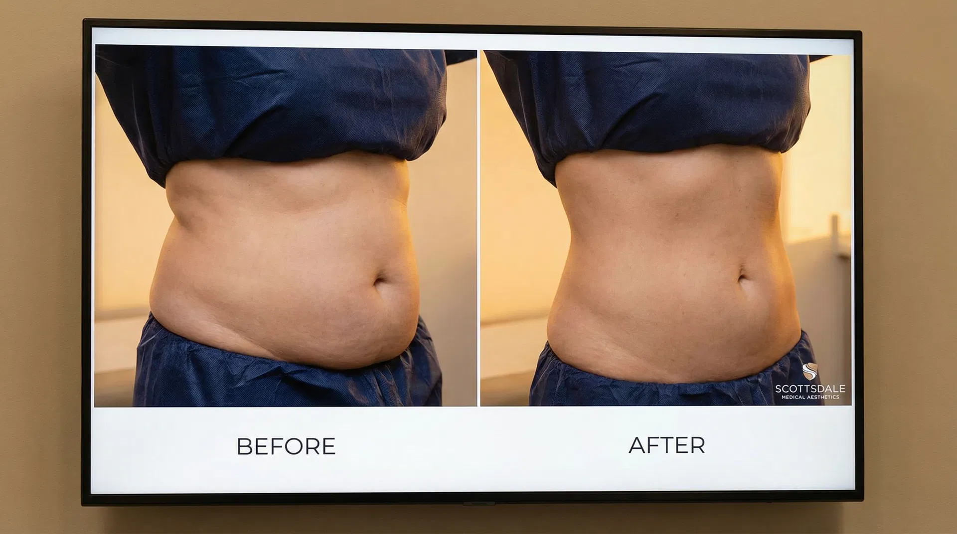 Before and after side by side showing waistline and flank contouring improvement from laser lipo