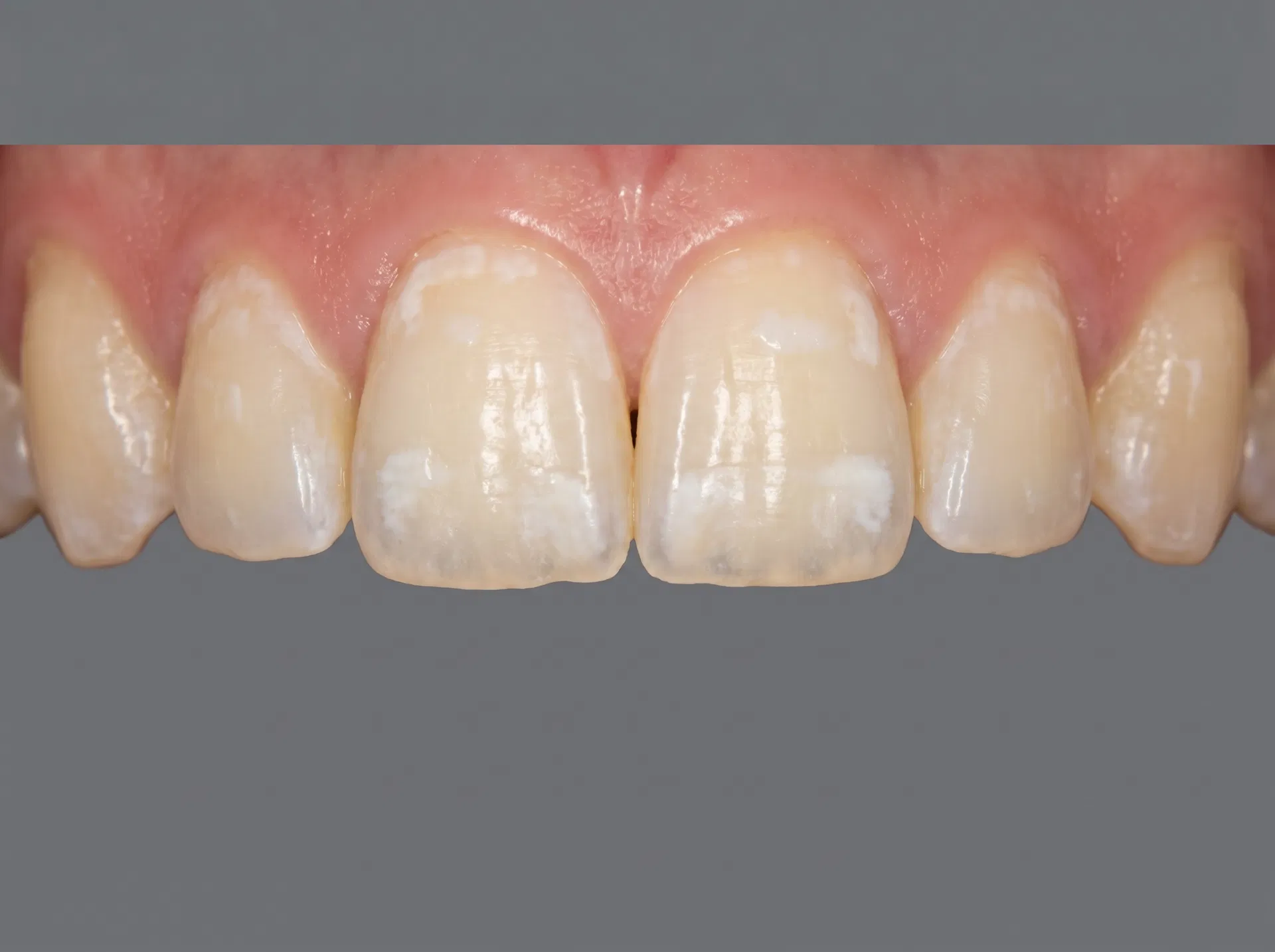 Après bagues / orthodontie