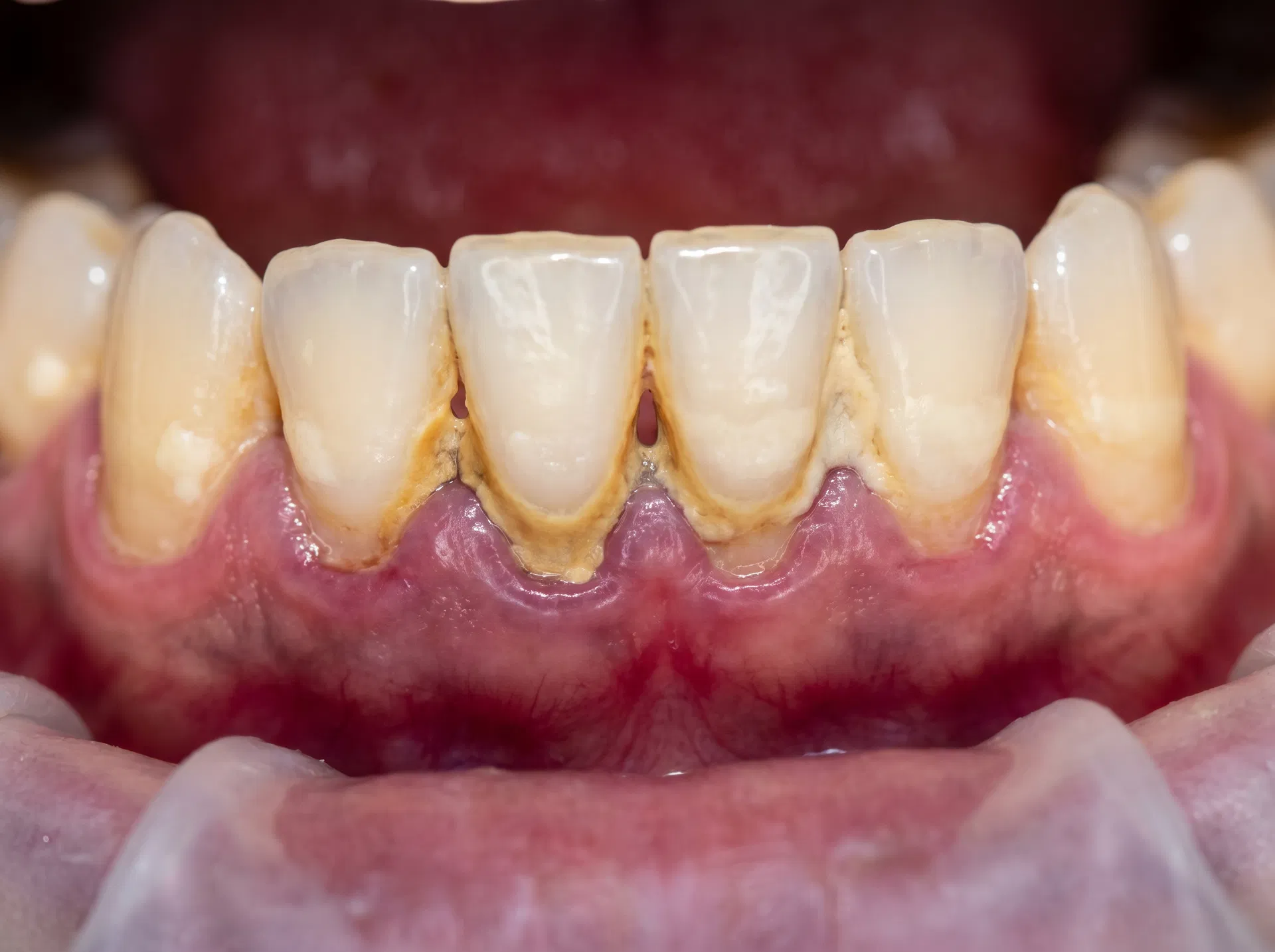 Tartre et plaque dentaire