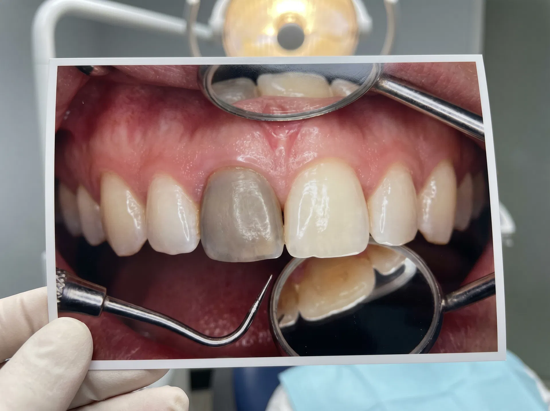 Traumatisme / Dent dévitalisée