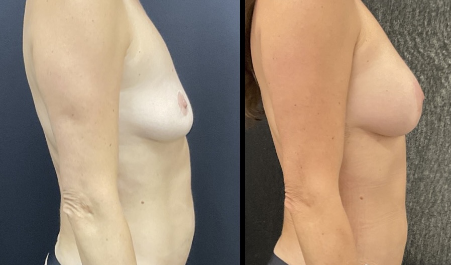 Before & After with Fat Transfer — Patient result