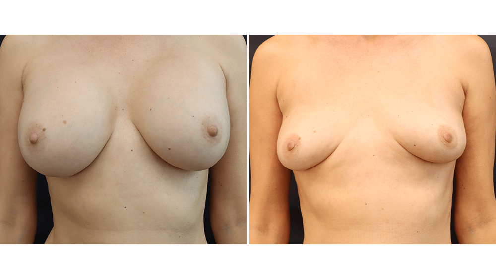 Breast Implant Removal + Fat Transfer — Patient result