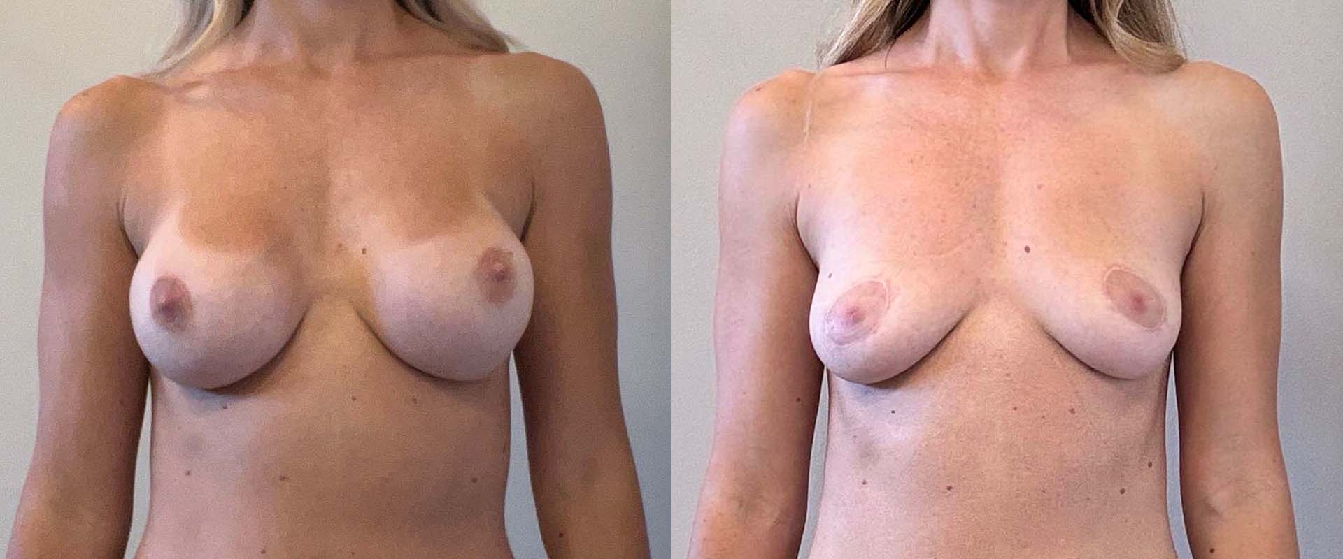Breast Implant Removal + Lift + Fat Transfer — Patient result