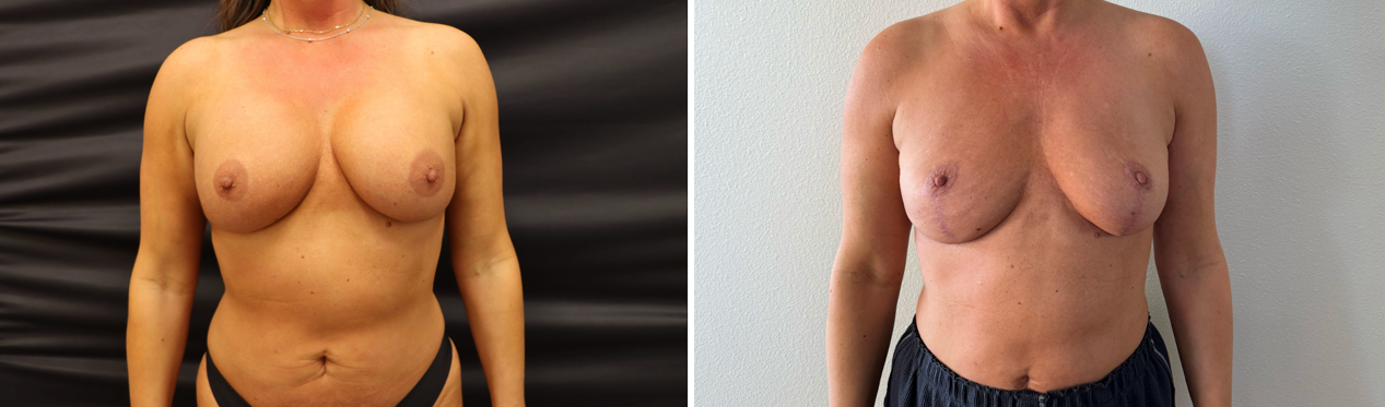 Breast Implant Removal + Lift + Fat Transfer — Patient result