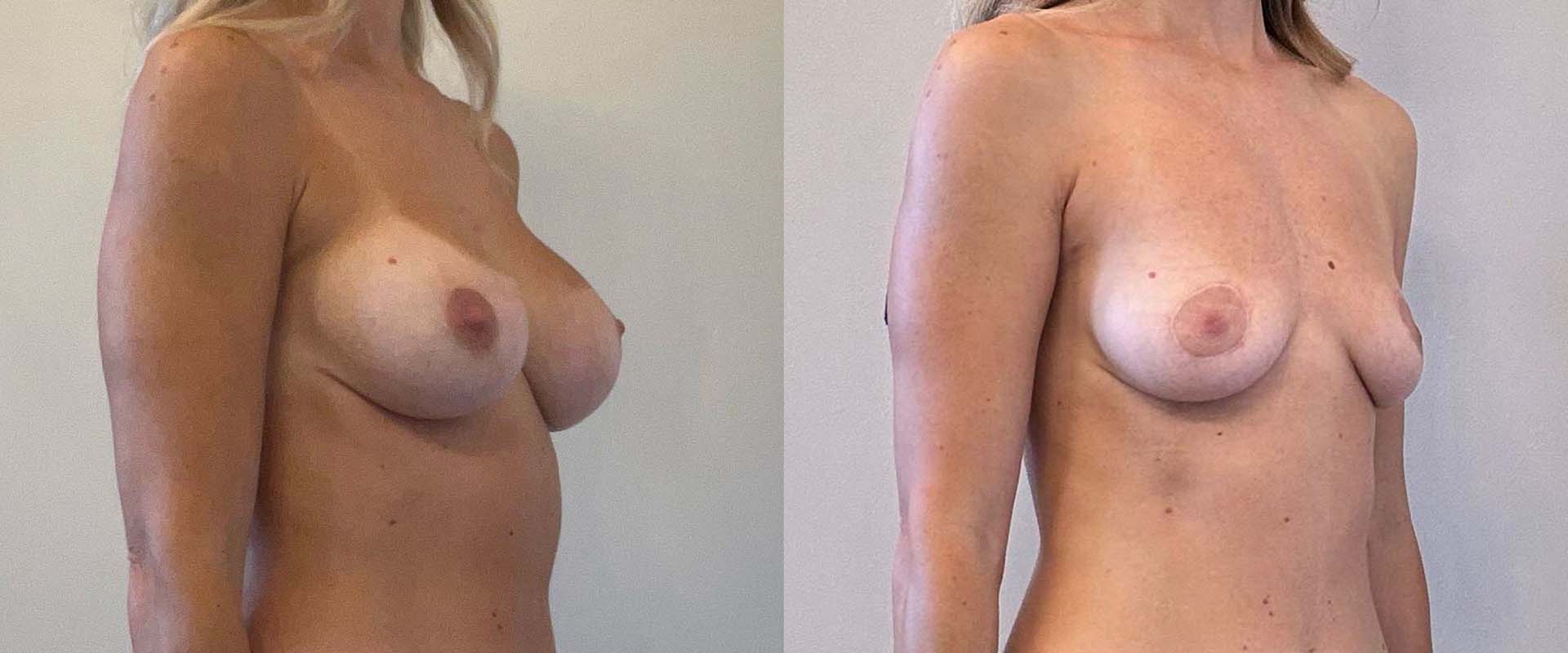 Breast Implant Removal + Lift + Fat Transfer — Patient result
