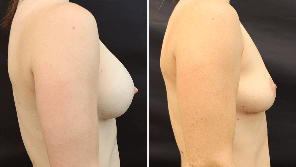 Breast Implant Removal + Lift — Patient result