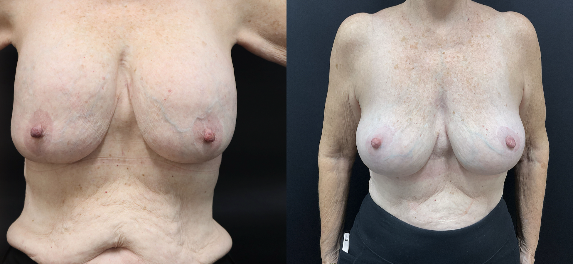 Breast Implant Removal + Lift — Patient result