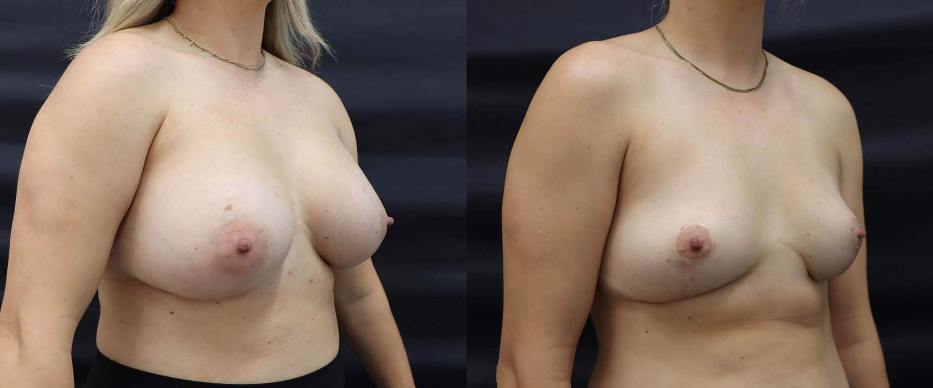 Breast Implant Removal + Lift — Patient result