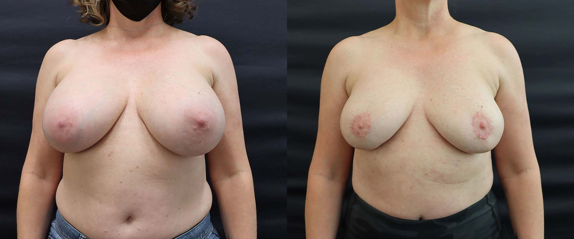 Breast Implant Removal + Lift — Patient result