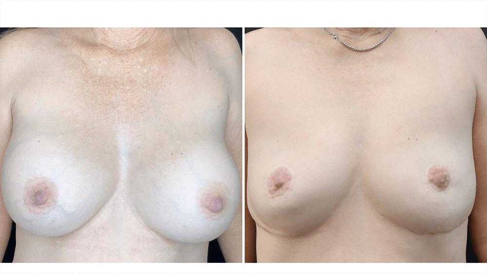 Breast Implant Removal + Lift — Patient result