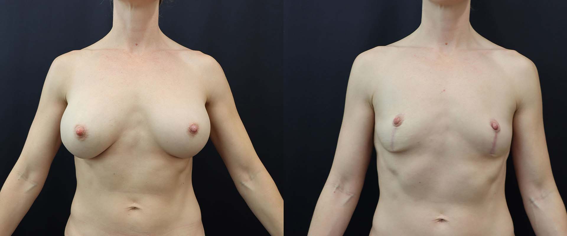 Breast Implant Removal + Lift — Patient result