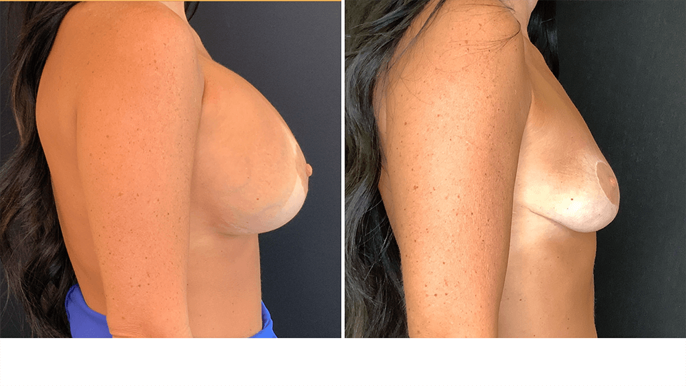 Breast Implant Removal — Patient result