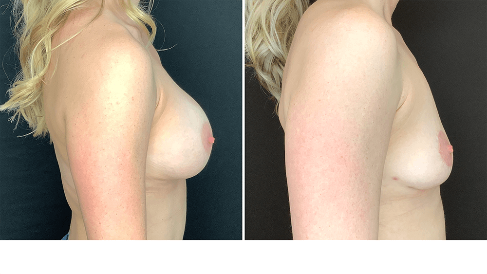 Breast Implant Removal — Patient result