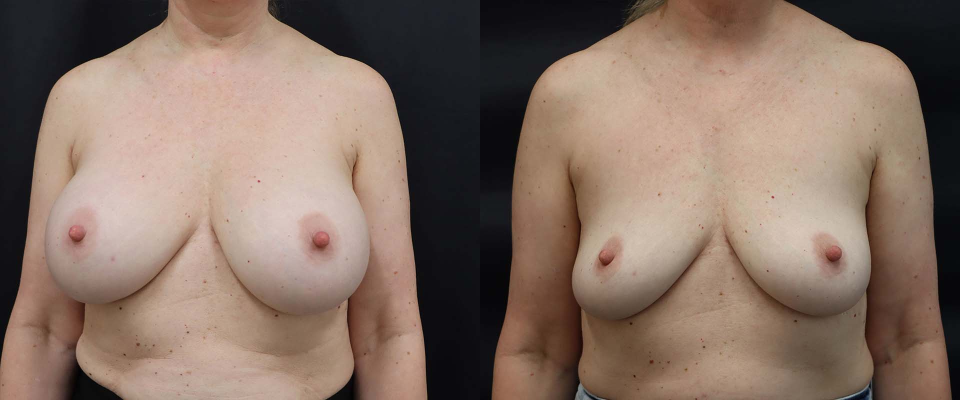 Breast Implant Removal — Patient result