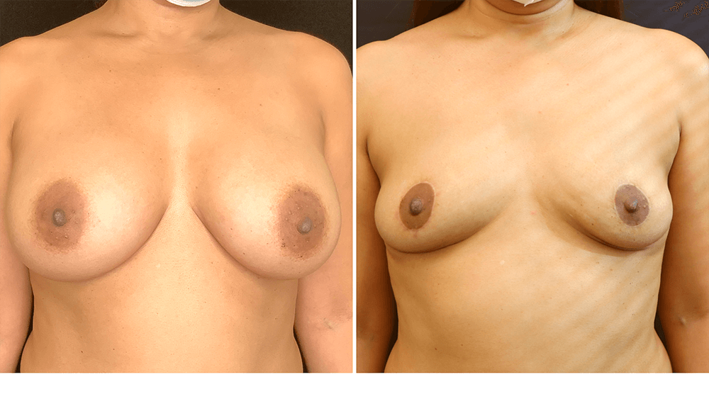 Breast Implant Removal — Patient result