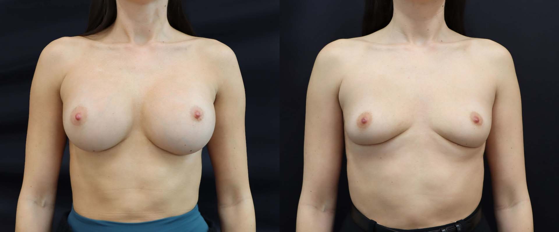 Breast Implant Removal — Patient result