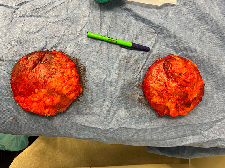 Capsules — Patient result