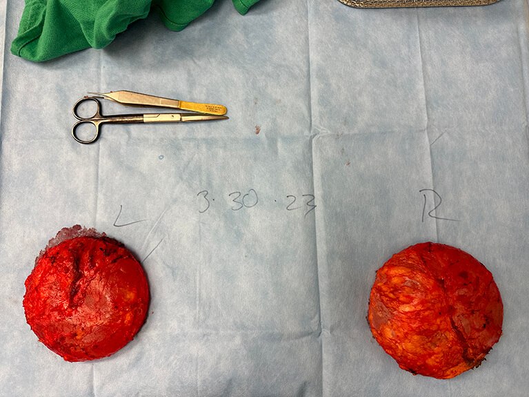 Capsules — Patient result