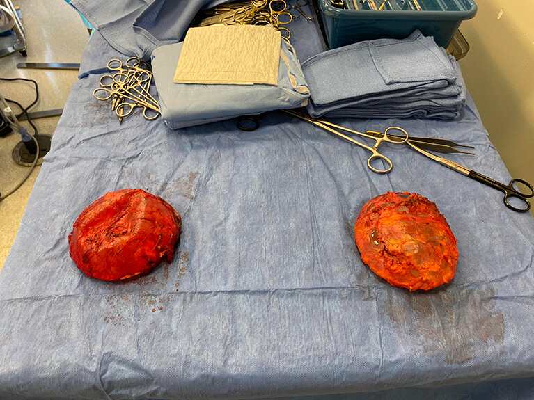 Capsules — Patient result