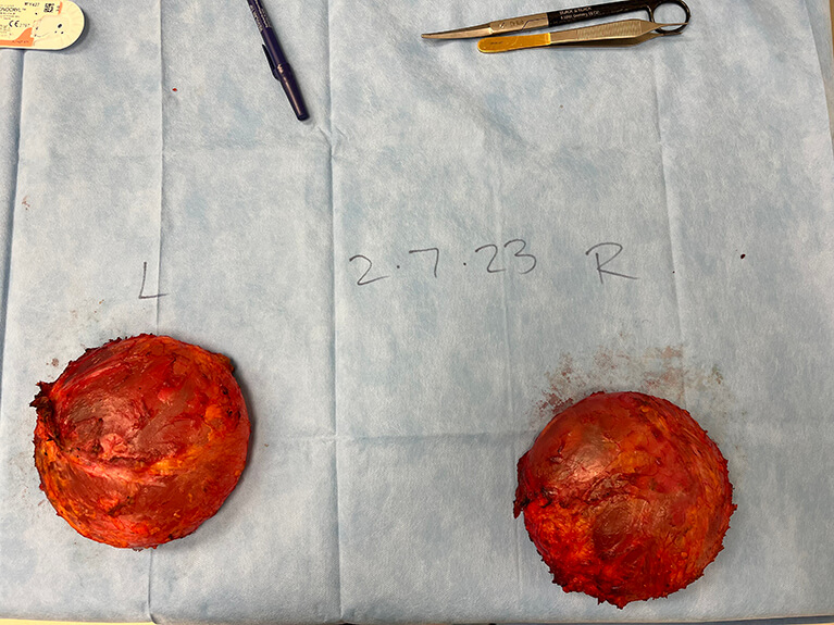 Capsules — Patient result