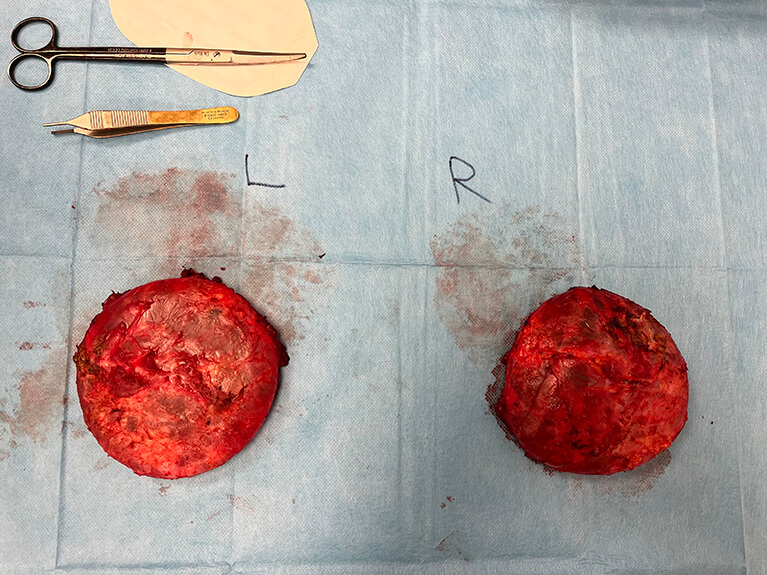 Capsules — Patient result