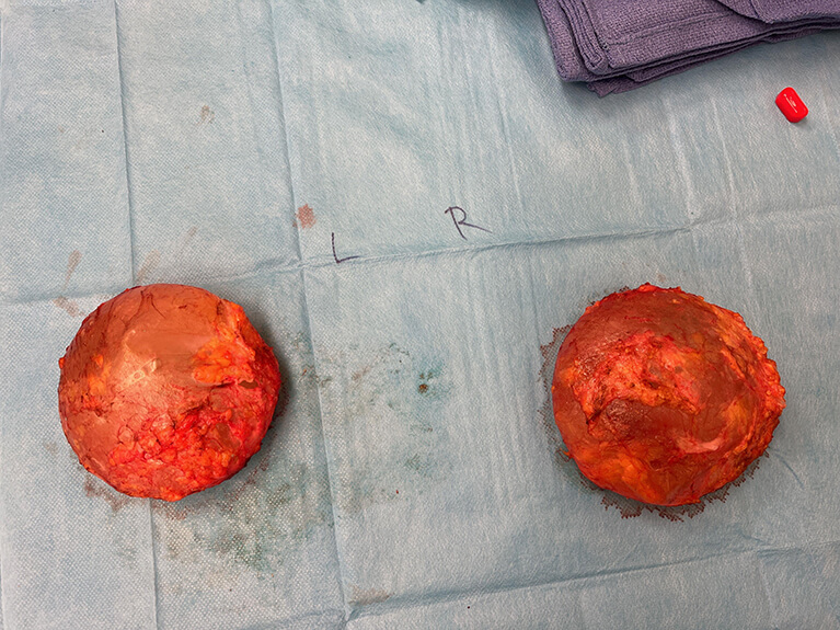 Capsules — Patient result