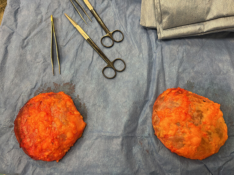 Capsules — Patient result