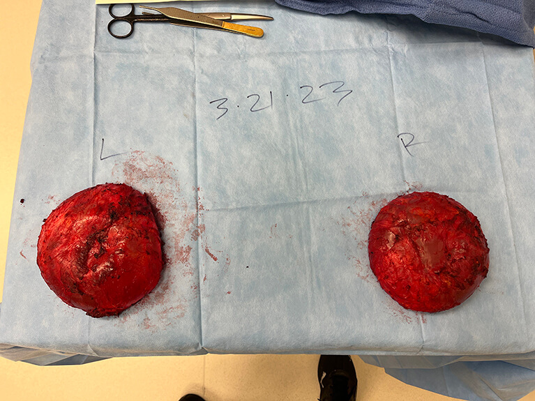 Capsules — Patient result