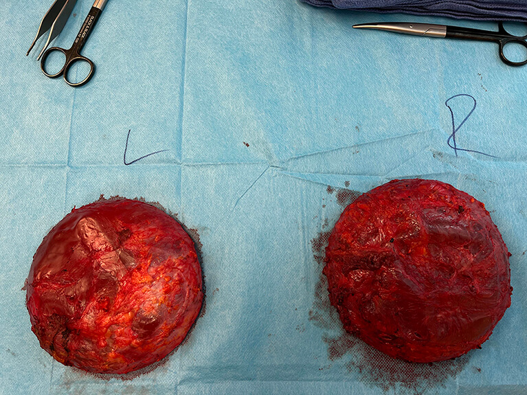 Capsules — Patient result