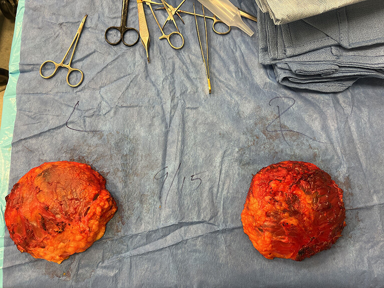 Capsules — Patient result